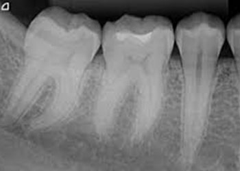 Tooth X-ray – Best Dental Clinic in Chennai