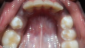 Crowding of Teeth – Rayen Dental Clinic