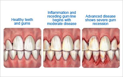 Progressive Gum Disease – Rayen Dental Care