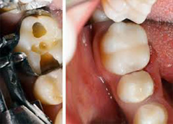 Tooth Treatment – Best Dental Clinic in Chennai