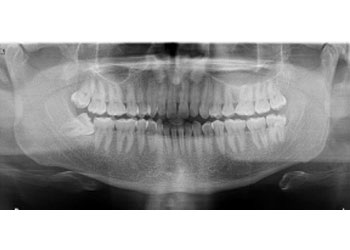 X-ray of Tooth Set – Rayen’s Dental Centre