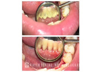 Tooth Treatment – Rayen’s Best Dental Hospital in Chennai