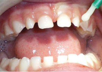 Gum Treatment – Best Dentistry near Chennai