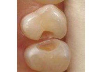 Tooth Treatment – Best Dentistry near Chennai