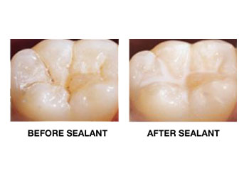 Sealant Treatment – Rayen’s Best Dental Care in Chennai
