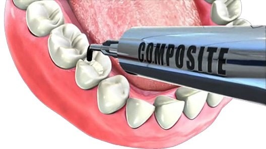 Composite in Dentistry