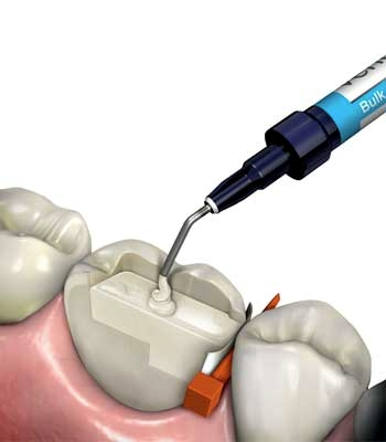 Composite in Dentistry – Rayen Dental Care