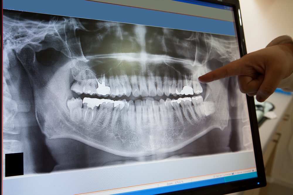 Importance of digital dental X-rays