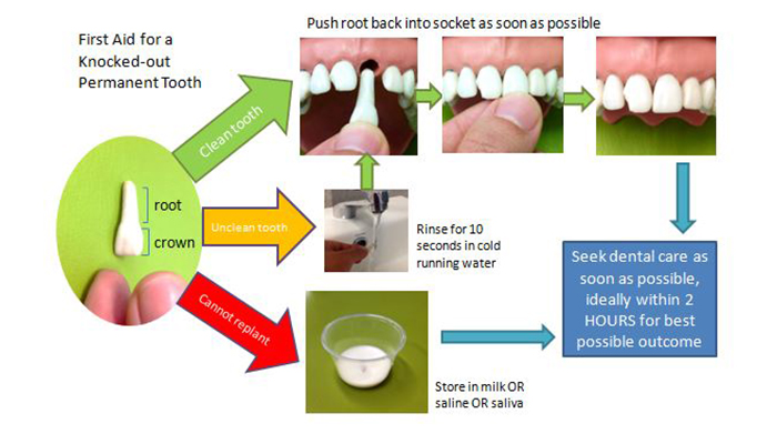 First Aid for a knocked-out Permanent tooth