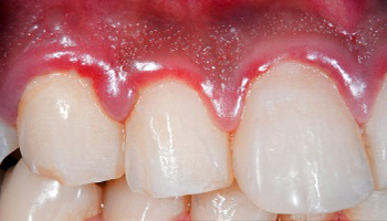 Progressive Gum Disease