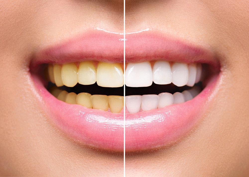 White Teeth – Rayen Dental Care