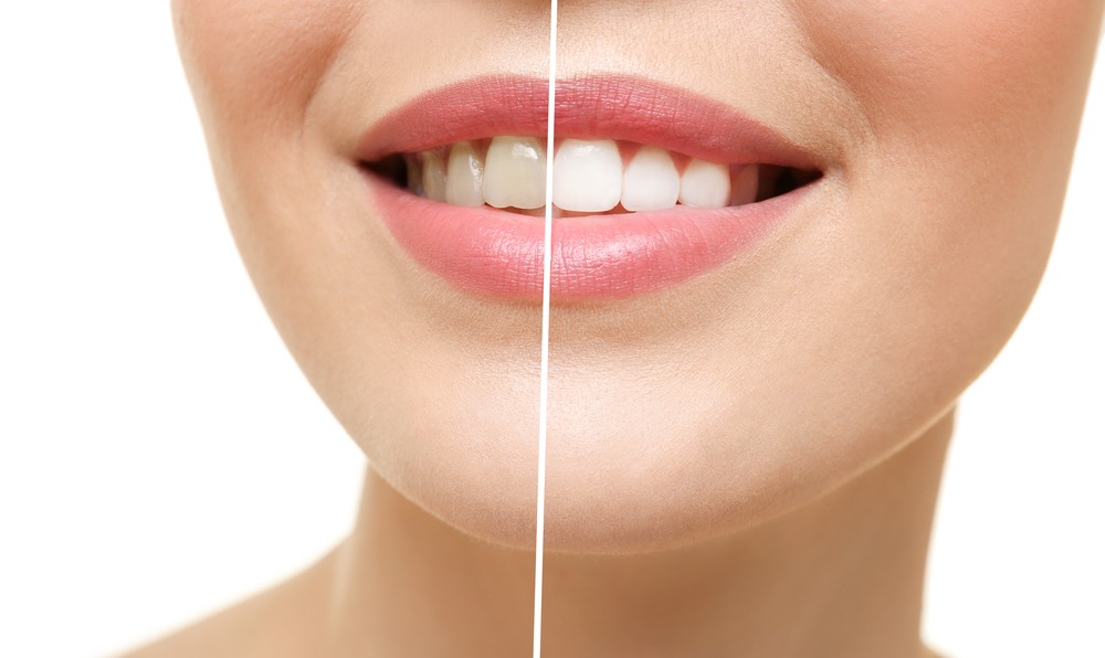 White Teeth – Dental Centre in Chennai