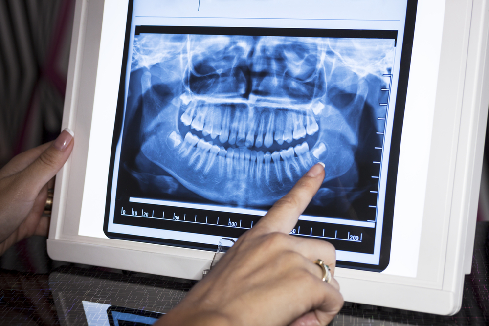 Digital x-rays in dentistry