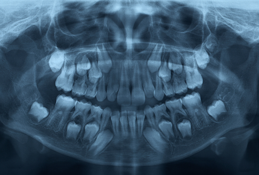 X-ray for Children – Rayen’s Dental Centre