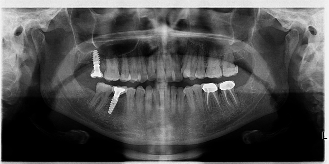X-ray – Best Dental Clinic in Chennai