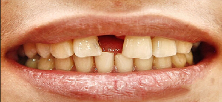 Prosthodontic Teeth Replacement Chennai
