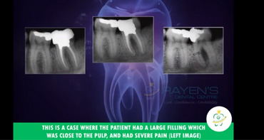 Pre-Op and Post-Op Radiography of a patient - Best Dental Care in Chennai