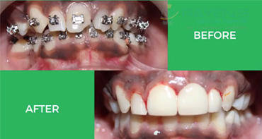 Intellectual combination of Braces and Implants - Best Implant Centre in Chennai