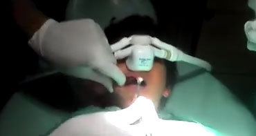 NOIS for a child - Inhalation sedation - Best Sedation Dentistry in Chennai