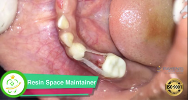Resin Space Maintainer – Best Dental Clinic in Chennai